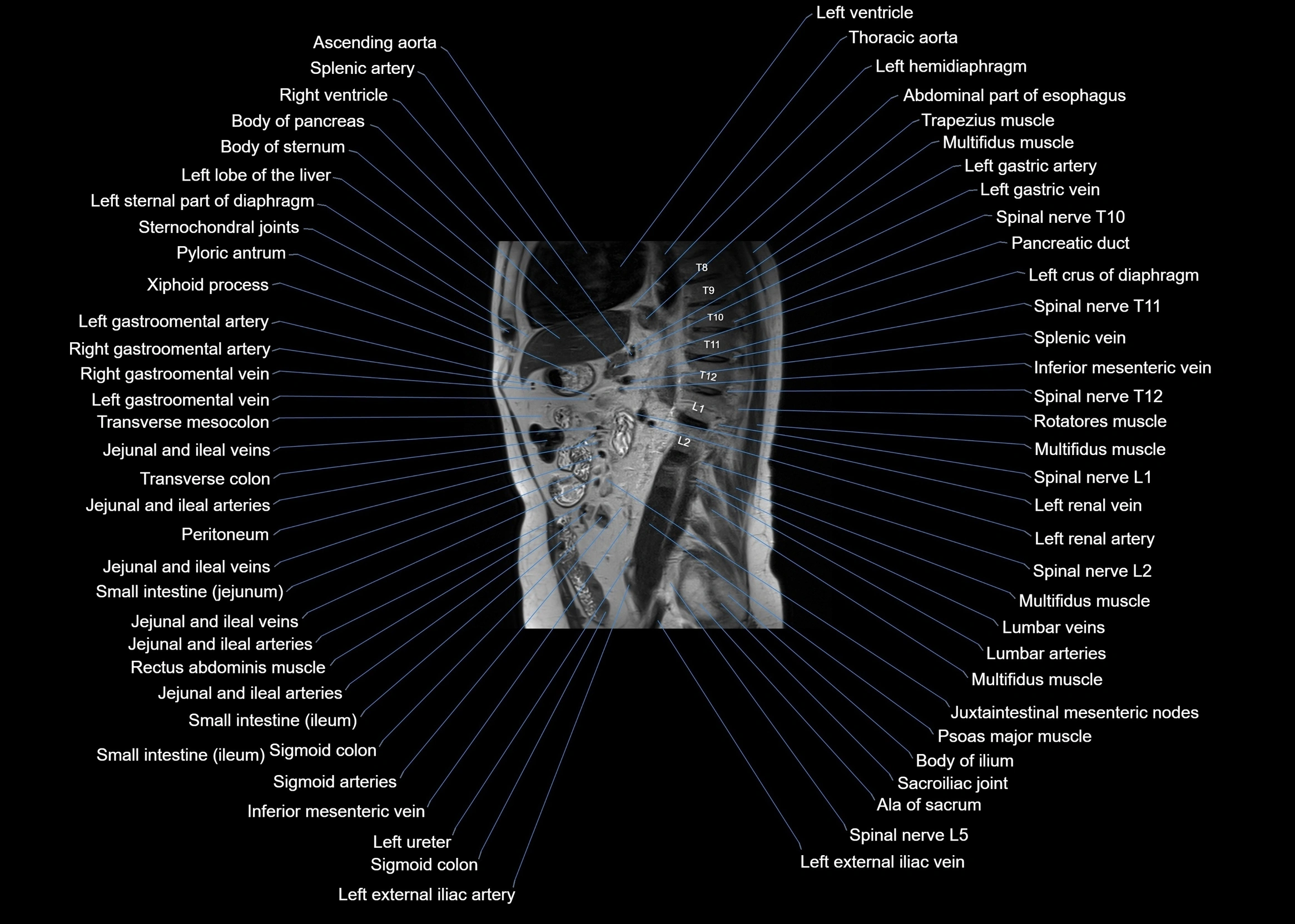 MRI abdomen sagittal cross sectional anatomy  radiology  image-img-00001-00041.webp